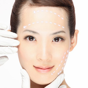 Căng trán bằng chỉ Collagen